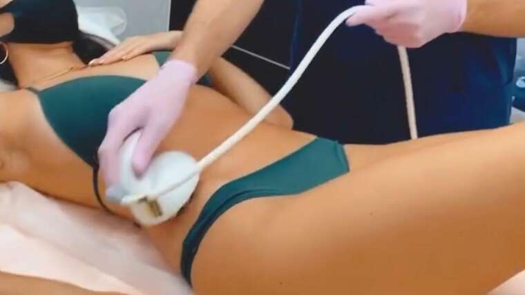 Cryolipolysis and RF lifting