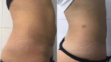 Cryolipolysis: fat removal in Miami