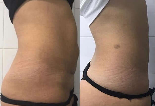 Cryolipolysis: fat removal in Miami