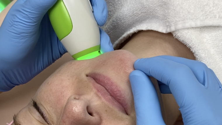 Facial Microdermabrasion