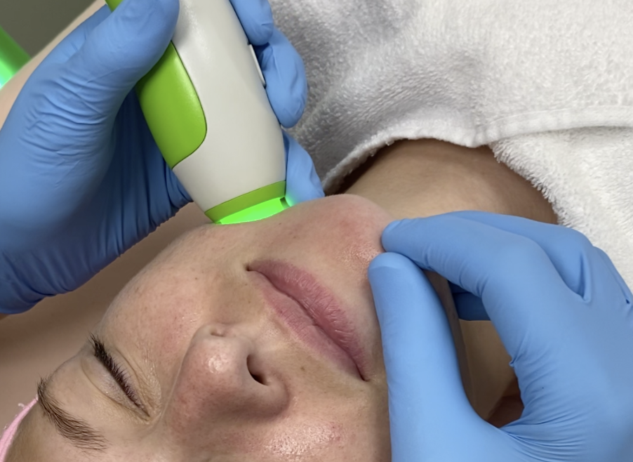 Facial Microdermabrasion