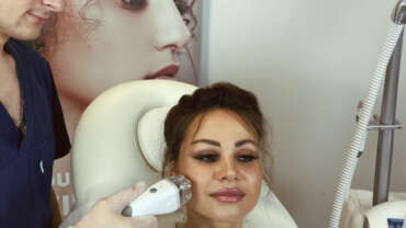 Spider Veins Removal