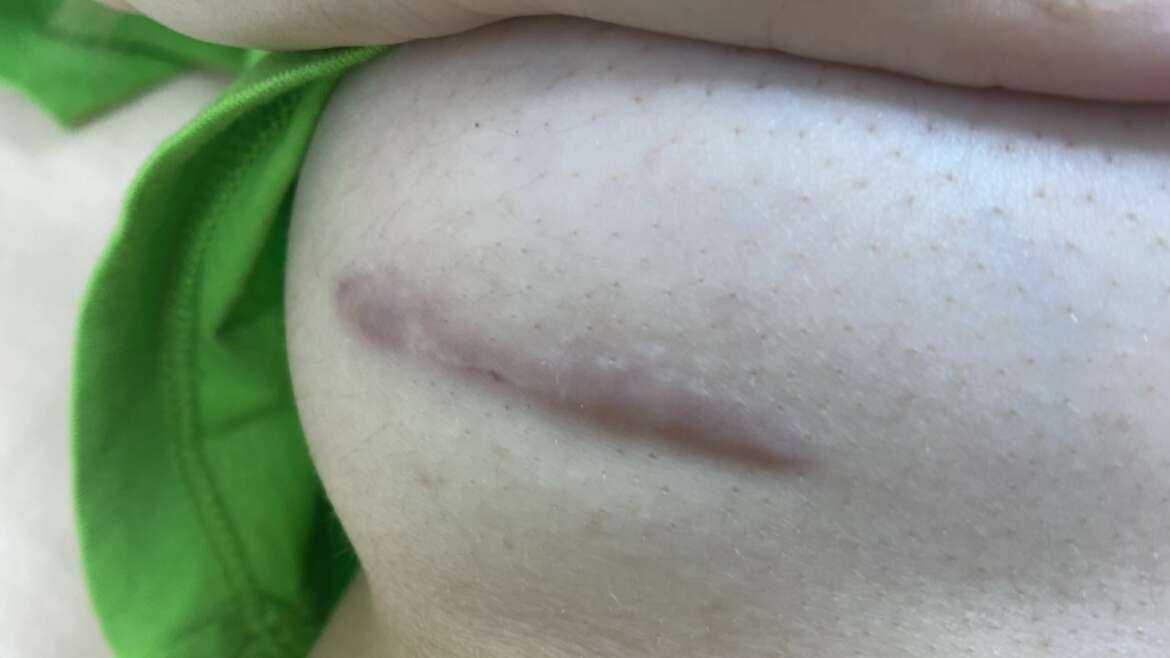 How much does a breast lift price? the cost of enhancing your natural beauty