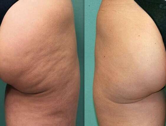 How to camouflage and hide cellulite?
