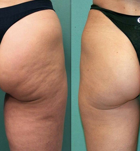 How to camouflage and hide cellulite?
