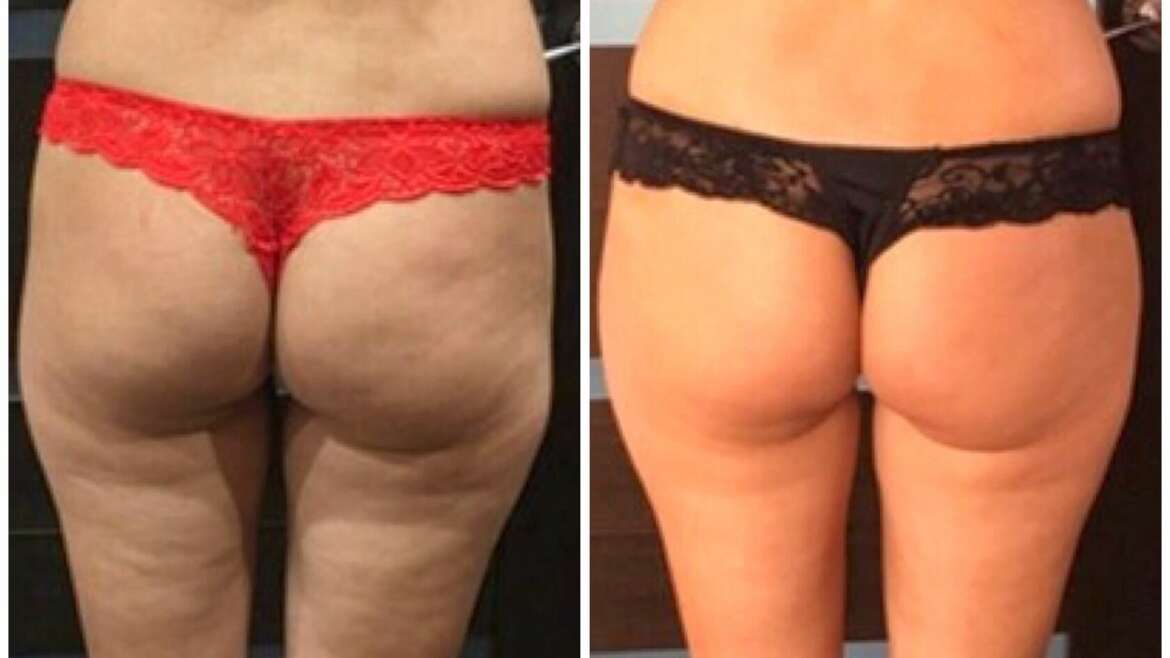 14 TREATMENTS TO GET RID OF CELLULITE ON THIGHS AND BUTT