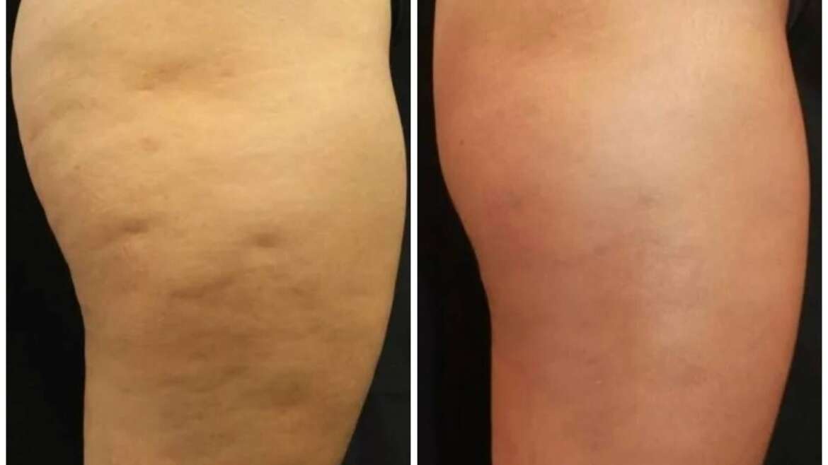 HOW MUCH DOES CELLFINA COST? UNDERSTANDING THE PRICE OF CELLULITE REDUCTION