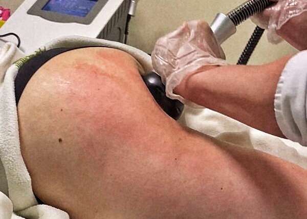 How Long Does Vacuum Therapy for Buttocks Really Last?