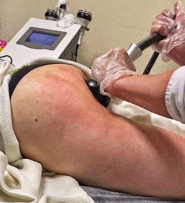 How Long Does Vacuum Therapy for Buttocks Really Last?