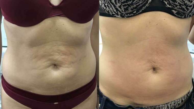 WHAT IS BODY CONTOURING (SCULPTING)? YOUR ULTIMATE GUIDE