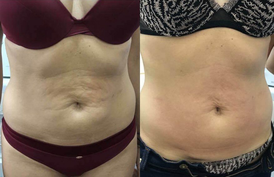 WHAT IS BODY CONTOURING (SCULPTING)? YOUR ULTIMATE GUIDE